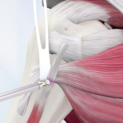 No More Tendon Wrap with TenoLok