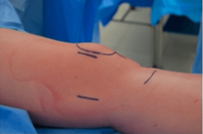mpfl-surgical-prep