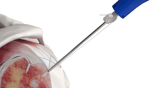 smart-tension-technology