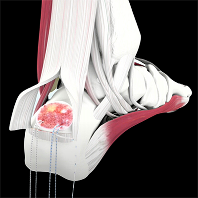 animation of a foot and ankle procedure with sutures being placed