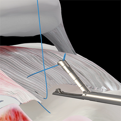 animation of sutures and suture passer working in a shoulder procedure