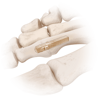 AlloAid Implants | CONMED