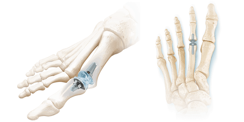 RTS 1st And Lesser Implants