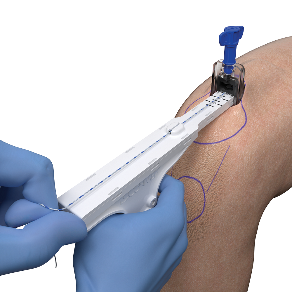 Illustration of a surgeon using the Infinity system on the knee during proximal-to-distal quad tendon harvest