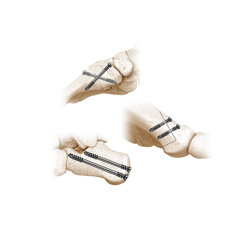 CoLag<sup>&reg;</sup>-Kompressionsschrauben&nbsp;<br />