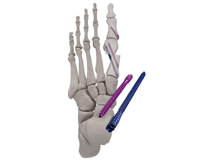 IBS™-B ​​Schrägschrauben