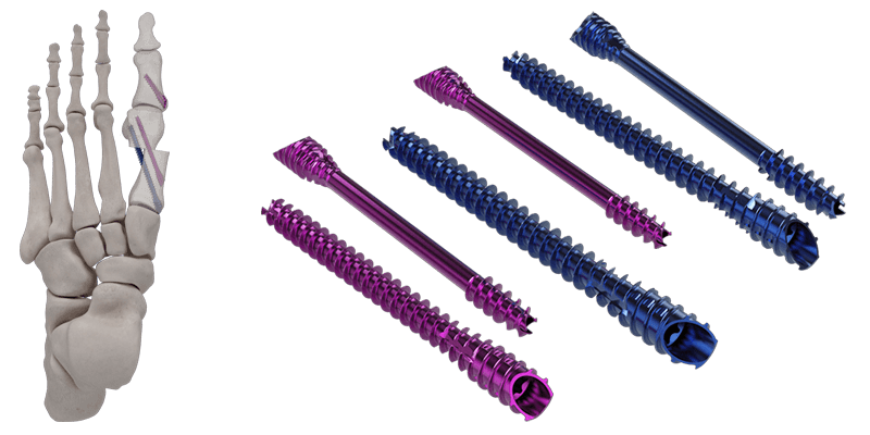 IBS™-B Beveled Screws