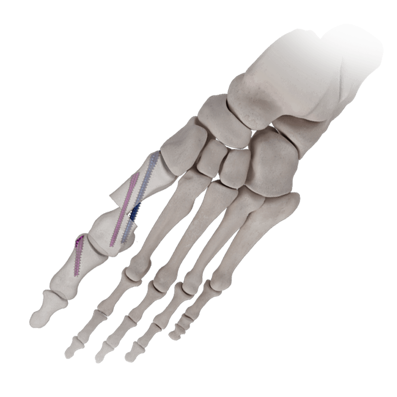 IBS™-B ​​Schrägschrauben