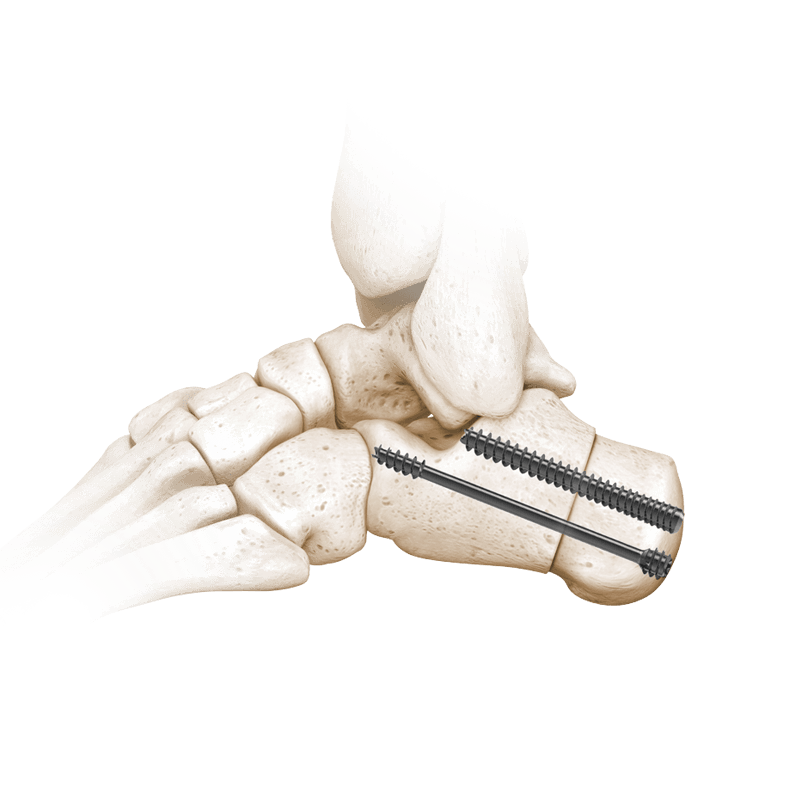 I.B.S.&trade; Abreiß- und Kompressionsschrauben