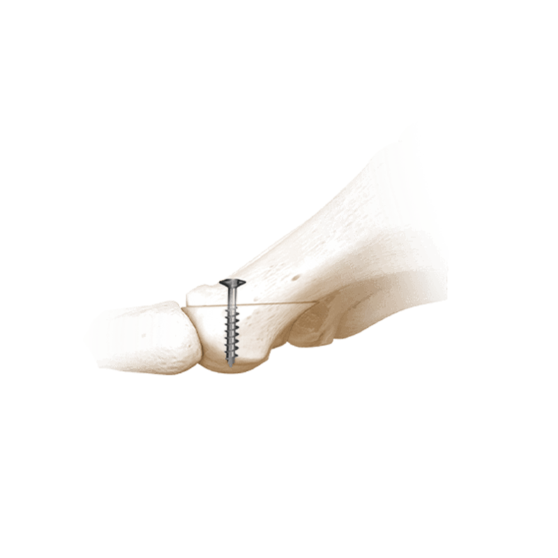 I.B.S.™ Abreißschrauben