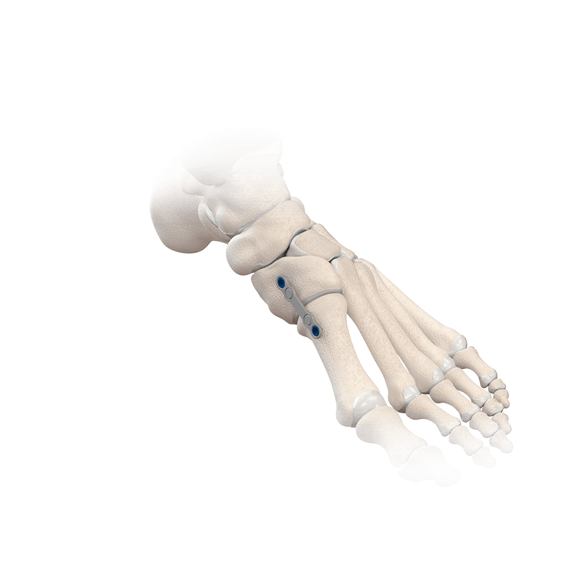 NeoSpan<sup>®</sup> Kompressionsimplantatsystem