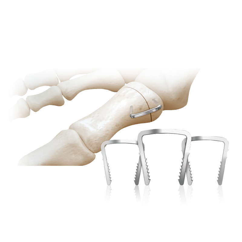 NeoSpan® SE Kompressionsklammern