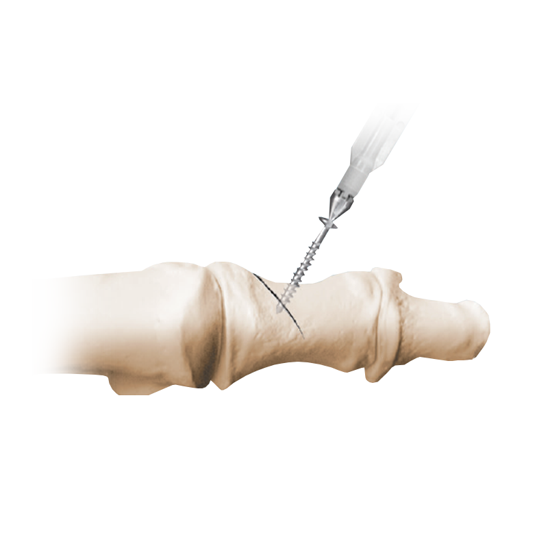 Instrumentación de un solo uso NeoSys<sup>&reg;</sup>