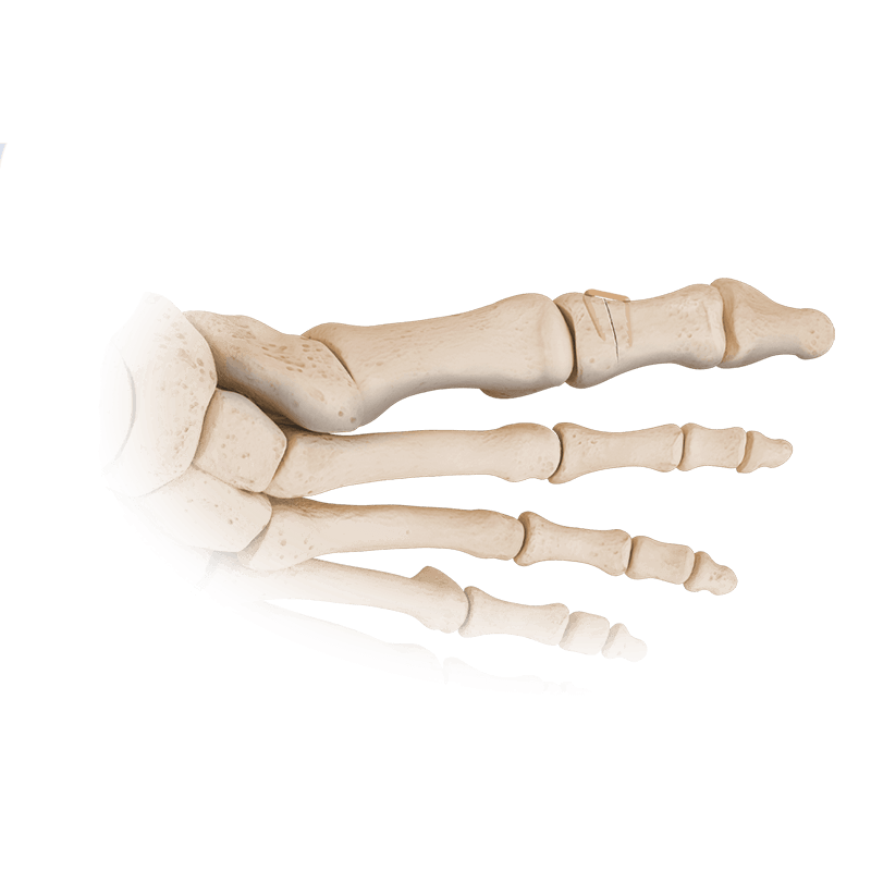 Grapas de compresión OS2-VP&trade;