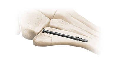 5ms jones fracture screw