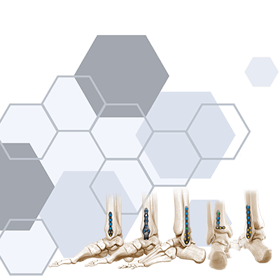 CoLink Afx Ankle Fracture Plating System | CONMED