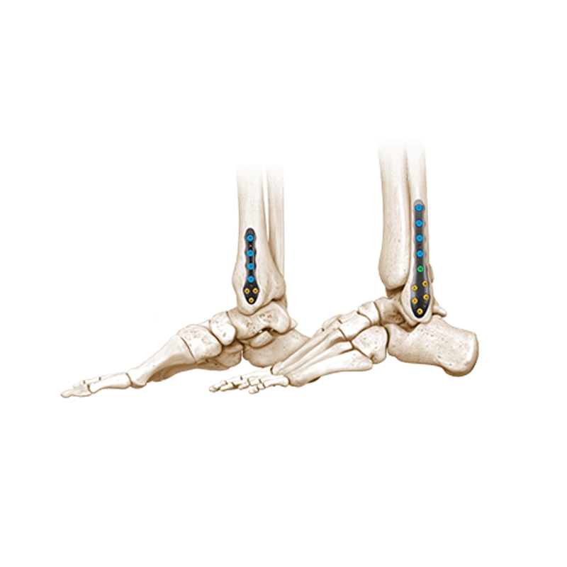 CoLink<sup>®</sup> Afx Ankle Fracture Plating System
