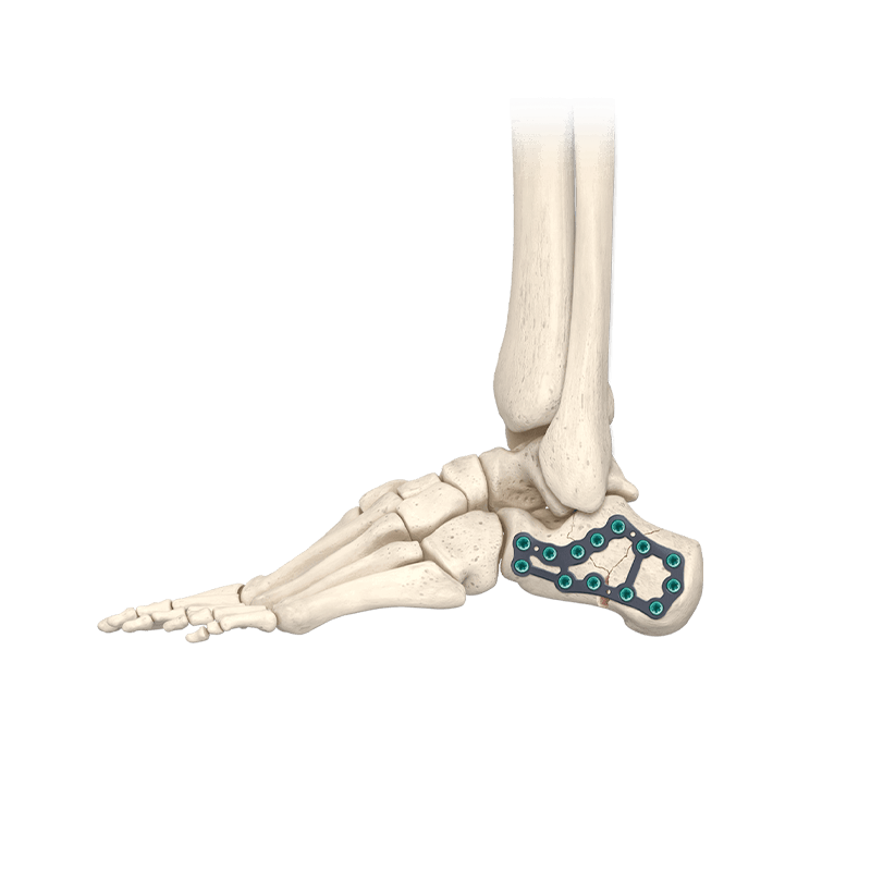 CoLink<sup>&reg;</sup>-Cfx-System zur Fixierung des Calcaneus