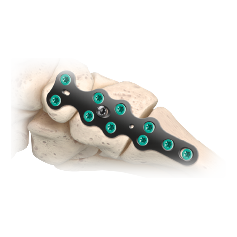 CoLink<sup>&reg;</sup>-Mfx-Plattensystem für den Mittelfuß