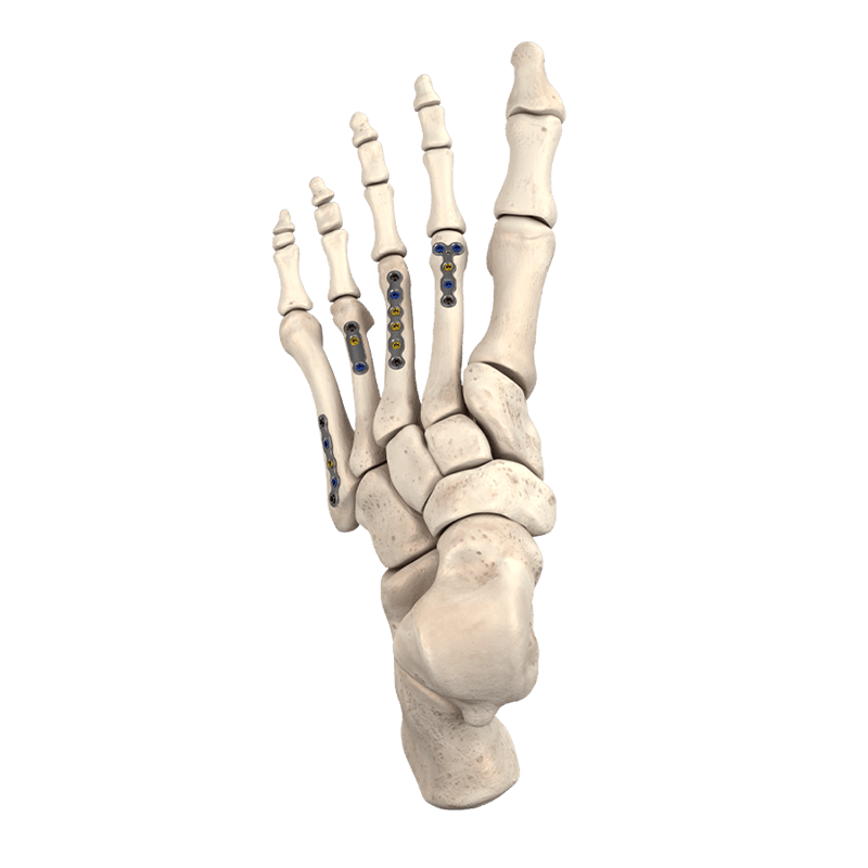 CoLink<sup>&reg;</sup> Mini-Dynamisches Plattensystem für die Kompression