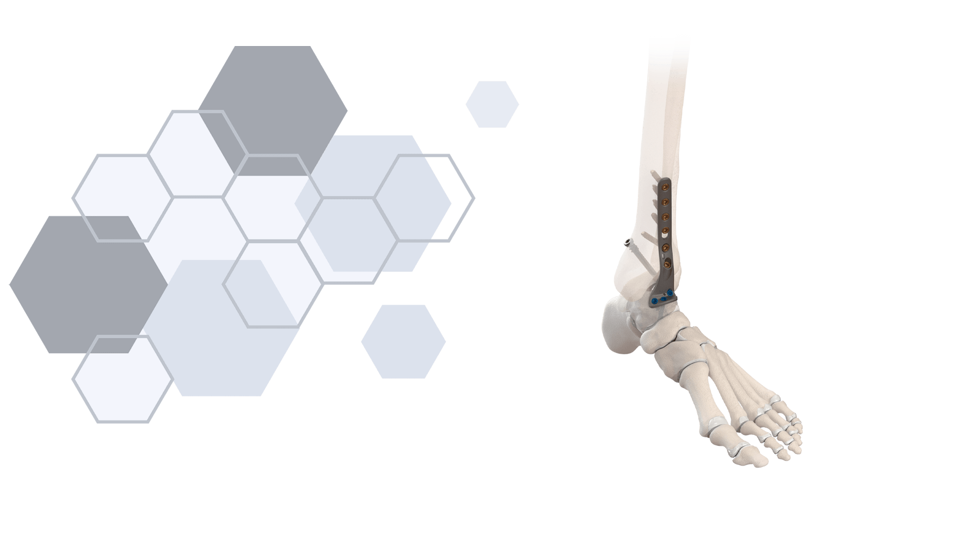Colink CoLink NeoFuse Knöchelfusionsplattensystem | CONMED