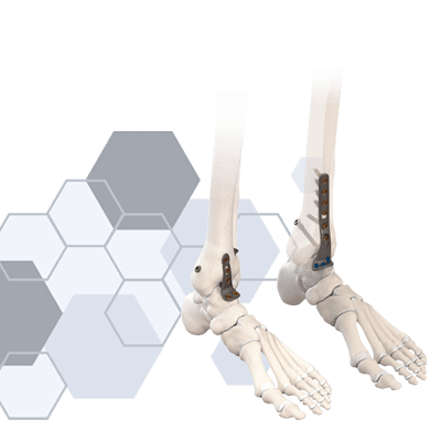 CoLink NeoFuse Ankle Fusion Plating System | CONMED