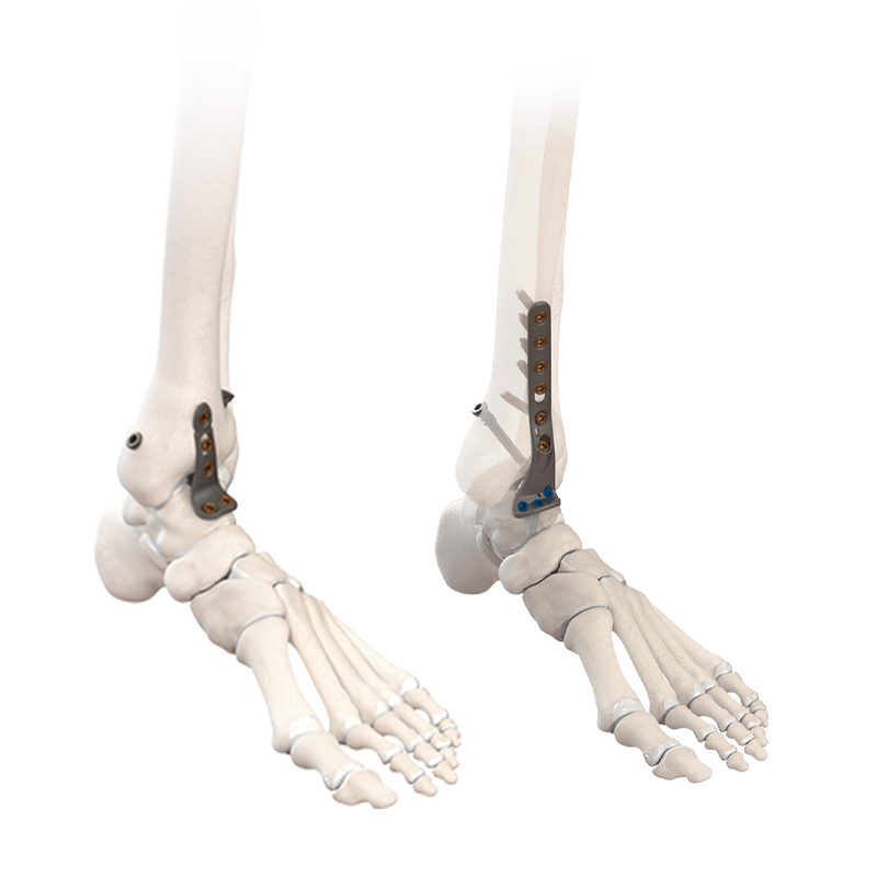 CoLink<sup>®</sup>  NeoFuse Ankle Fusion Plating System