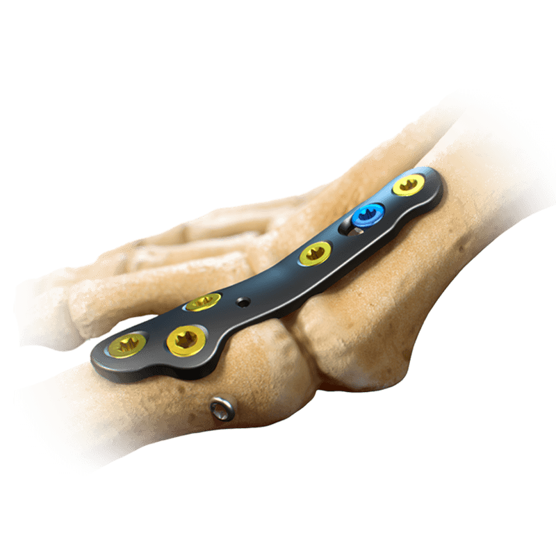 CoLink<sup>&reg;</sup> PCR Kohlenstofffaser Plattensystem