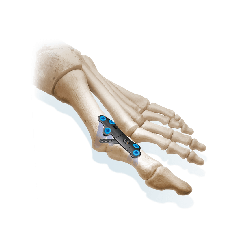 CoLink<sup>&reg;</sup>-XP-Plattensystem