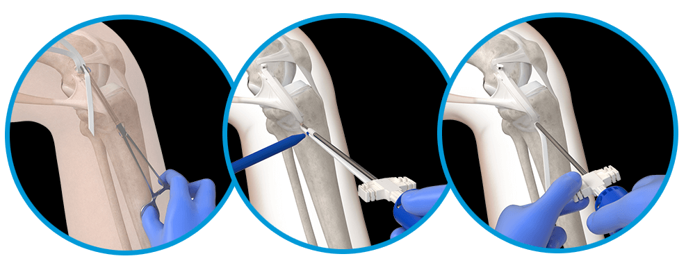Implantat distal verschieben, Spannung an das native Gewebe anpassen, zweiten Anker einsetzen, Überschuss abschneiden und verschließen