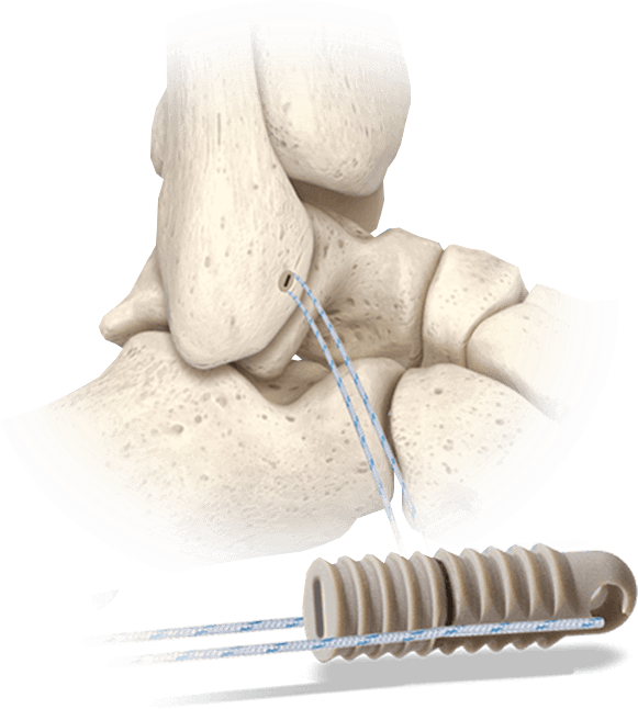 Hercules FT Knotless Diagram