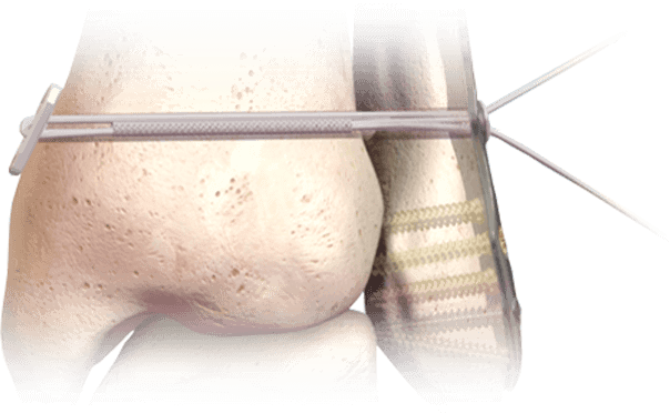 Diagrama del sistema de sindesmosis sin nudos de Hércules