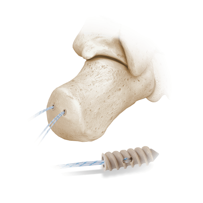 Anclaje de sutura completamente roscada Hercules<sup>®</sup>
