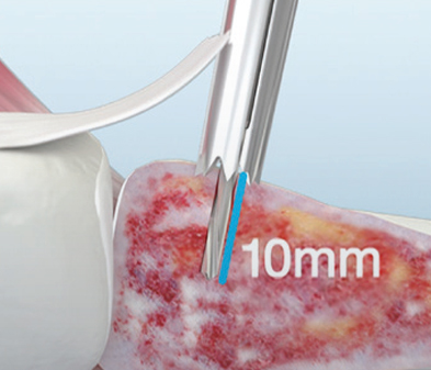 Ilustración TruShot de la profundidad de perforación de 10 mm