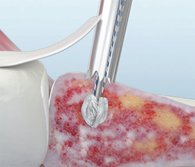 TruShot-Abbildung der starken Y-Knoten-Ankerfixierung