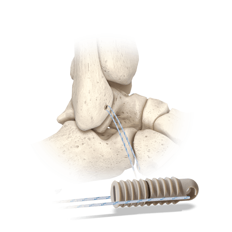 Hercules<sup>®</sup> Knotless Suture Anchor