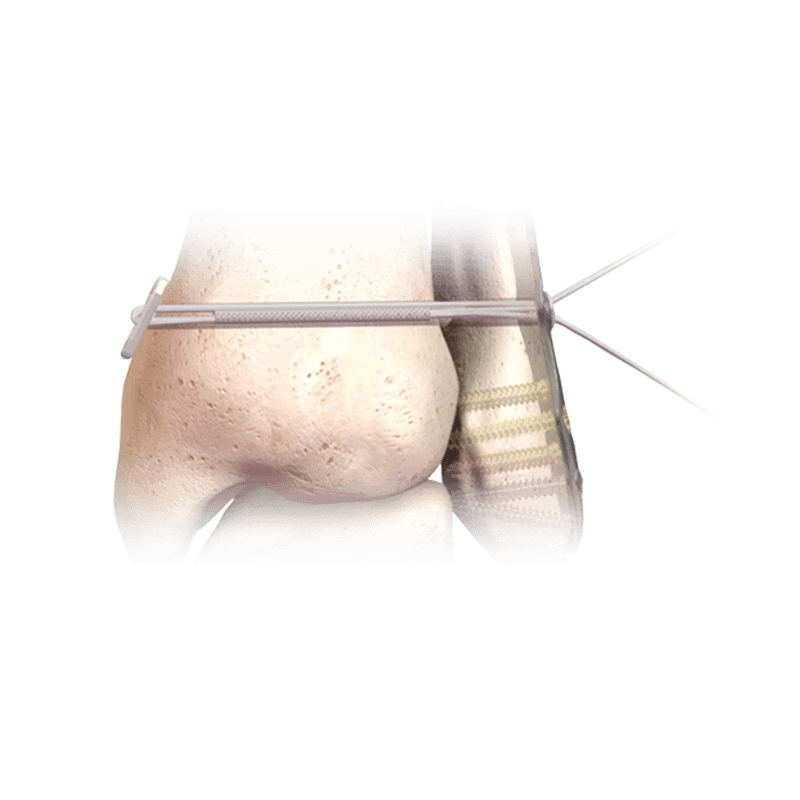 Hercules<sup>®</sup> Knotenloses Syndesmose-Implantat-System