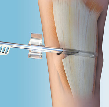 ClearGuard LE Gastrocnemius-Rezession