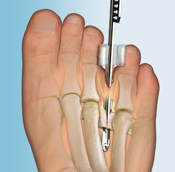 ClearGuard LE Nervenentlastung