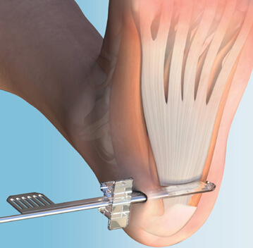 ClearGuard LE Plantarfaszienentlastung