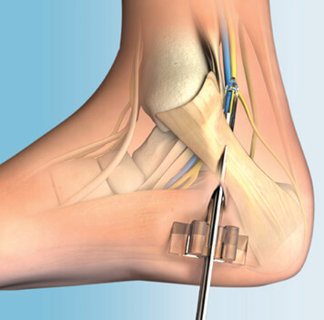 ClearGuard LE Tarsal Tunnel Release