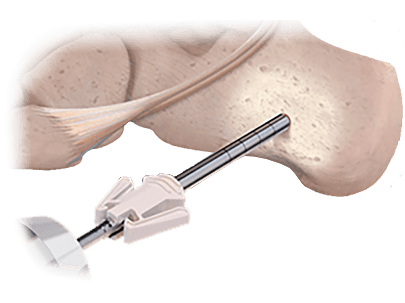 colink-bone-graft-harvester-hero