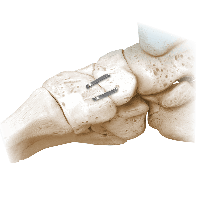 NeoSpan® SE Compression Staples