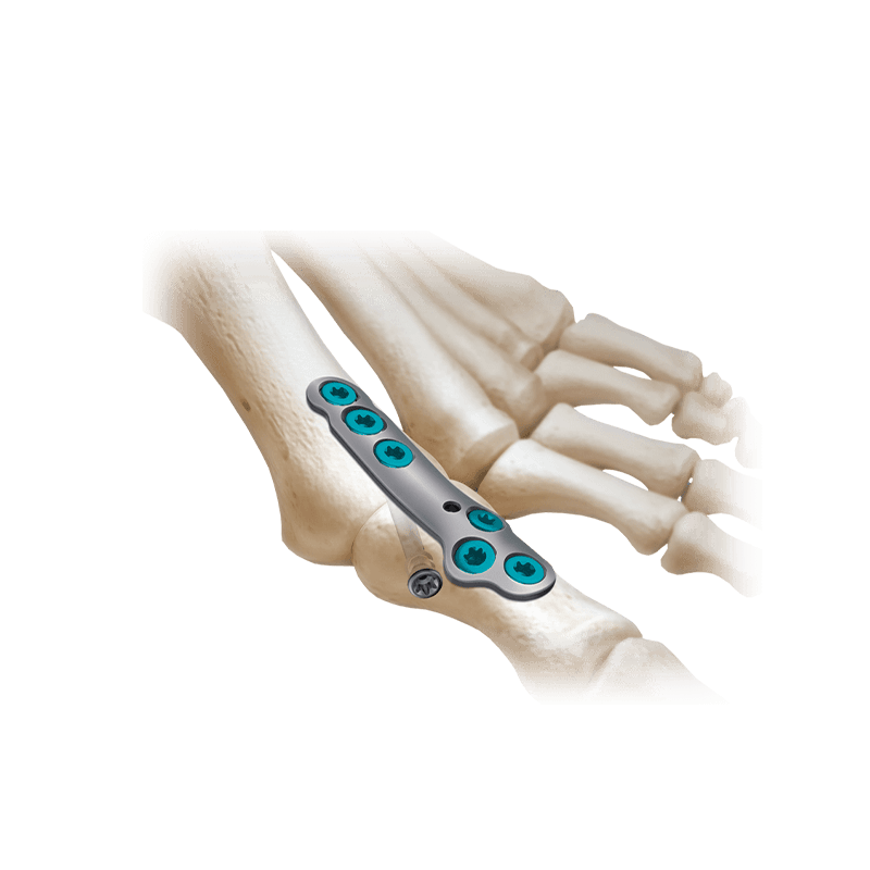 CoLink®2 Compression Plating System