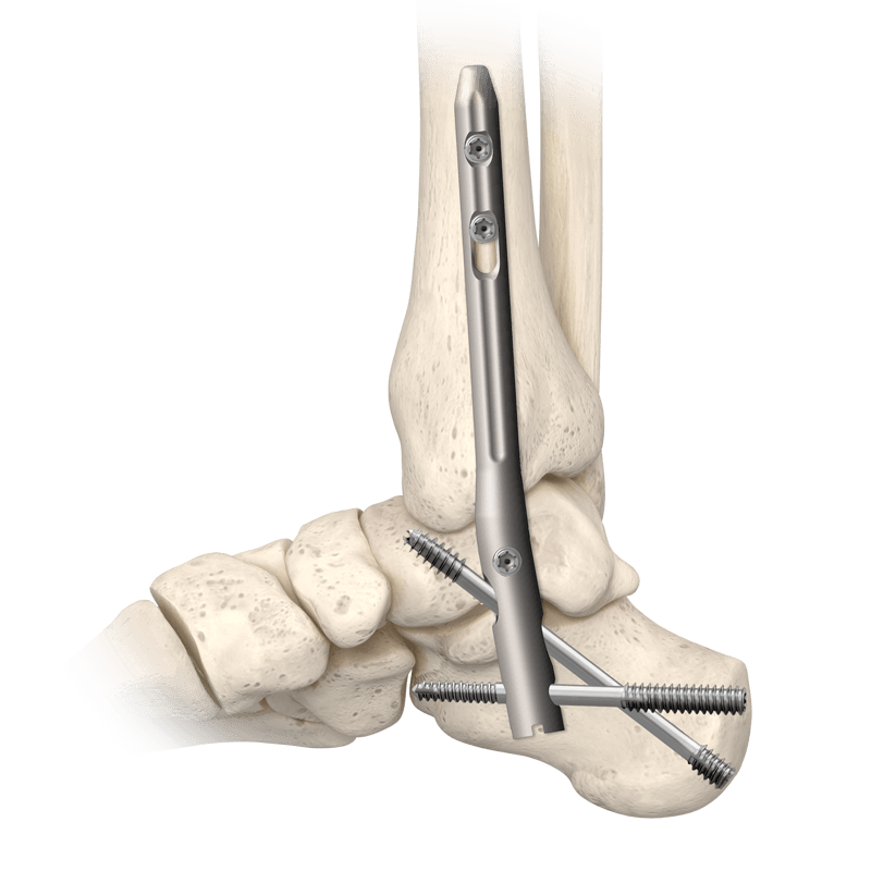 TriWay® Ankle Fusion Nail