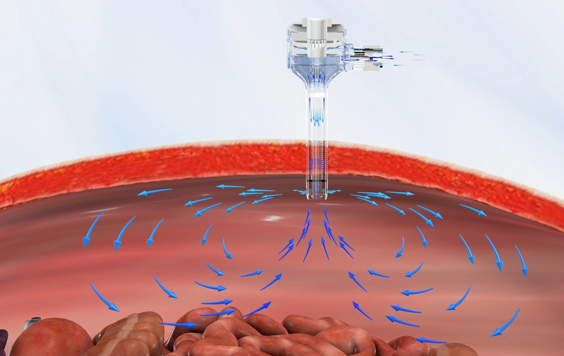 Surgical Field Visibility AirSeal CONMED