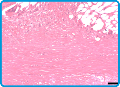 image of biobrace filled with new tissue