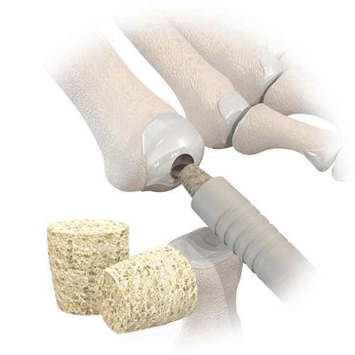 animation of alloaid subchon in bone