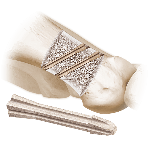 animation of alloaid bionail in bone