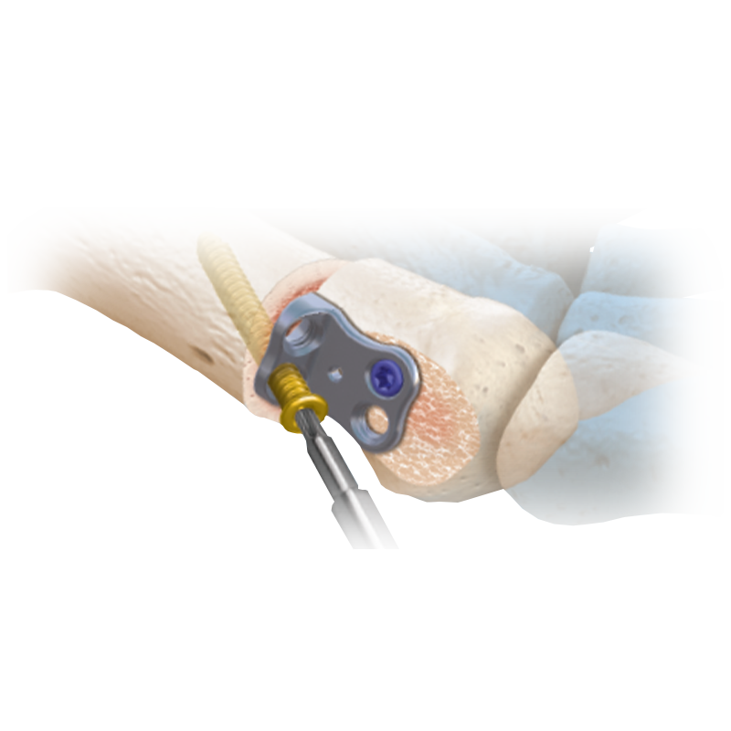 CoLink® Vallux Active Bunion Plating System
